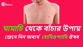 ঘামাচির হোমিওপ্যাথি চিকিৎসা | Homeopathy Treatment For Heat Rash/Prickly Heat - Dr Murad Ali.