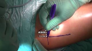 Anterior Approach Femoral Revision Surgery