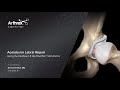 Acetabular Labral Repair Using the Knotless 1.8 Hip FiberTak® Soft Anchor