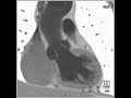 cardiac dilated aortic root and sinuses of valsalva 4 of 10