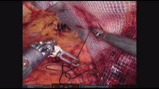 DMH Robotic Right Inguinal Hernia repair with Progrip mesh