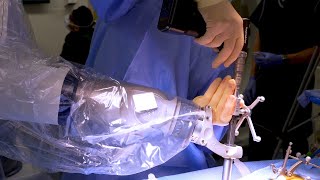 Robotic Spine Surgery Explained