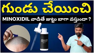 #AskDrJohnWatts | గుండు చేయించి  MINOXIDIL వాడితే జుట్టు బాగా వస్తుందా ? | Hair Specialist Explains