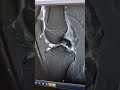 rupture du ligament croisé antérieur