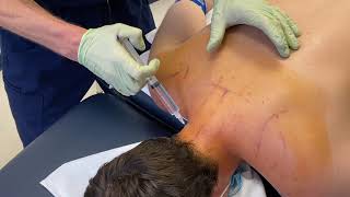 Prolotherapy & PRP Injections for Neck Pain & Instability