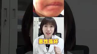 孩子有这个坏习惯 小心越变越丑口周皮炎 健康科普 医学科普 涨知识