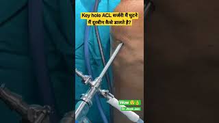 Key hole ACL सर्जरी मैं घुटने मैं दूरबीन कैसे डालते है? Dr Jitesh Jain #shorts #aclsurgery #acl