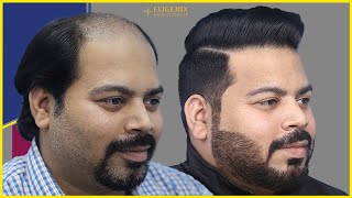 18 Months Hair Transplant update | Norwood Grade 5 @EugenixHairSciencesofficial​