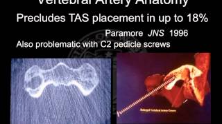 Precision in Instrumentation Placement: Where Are We?