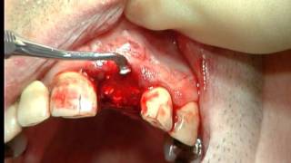 Extraction and filling with Bonit Matrix resorbable bone graft material