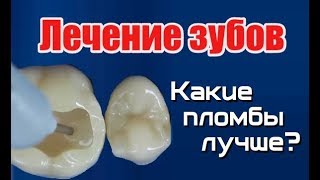 Лучшие пломбы при лечение зубов