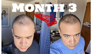 3 Months After My FUE Hair Transplant in Turkey | 4,550 Grafts | Cinik Clinic |