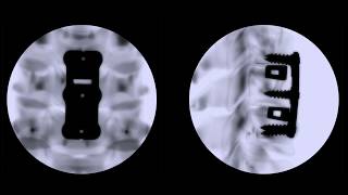 CoreLink Terrace Anterior Cervical Plate and SureSize Interbody Cage Systems