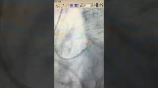 PCI stenting trifurcation LM- ŁAD- - remus- LCX