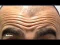 Brotox Forehead Lines Before and After - Men's Botox Results.