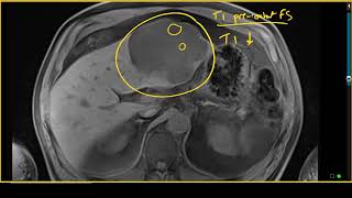 Giant Liver Hemangioma With Cystic Degeneration on MRI