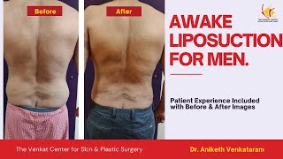 Awake Liposuction for Men| Can Exercise remove all types of Body Fat? Expert Opinion from Doctor