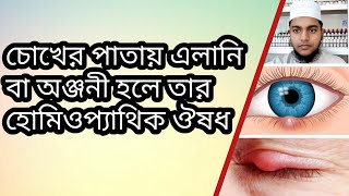 অঞ্জনী বা এলানি কেন হয়? এটি ভাল করার হোমিও ঔষধ। Homoeopathic Medicine for Stye