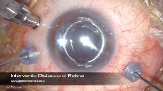 Intervento Distacco di Retina: operazione distacco di retina - Dr. Abbondanza