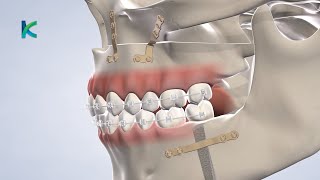 Orthognathic Jaw Surgery in Louisville, KY