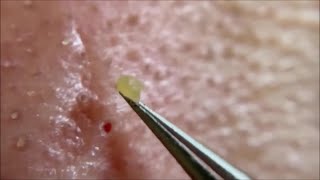 角栓除去,relaxSatisfying,nose blackheads,tweezers,acne treatment,いちご鼻,ピンセット,角栓抜き_13