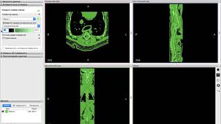 DICOM to STL (Перевод МРТ или КТ в 3D-модель)