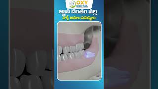 జ్ఞాన దంతం వల్ల వచ్చే సమస్యలు || What Problems can Wisdom Teeth Causes || Dr. Madhuri K | Oxy Dental