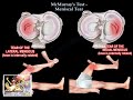 McMurray's Test,Meniscal Tear - Everything You Need To Know - Dr. Nabil Ebraheim