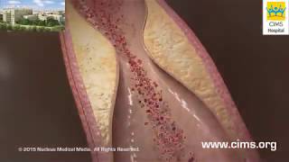 Coronary Artery Bypass Graft CABG - CIMS Hospital