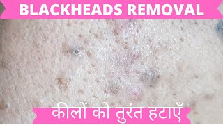 Permanent Blackheads Removal(Blackheads से पाये छुटकारा ) Dr Rekha |Dr Vineet |Bikaner Dermatologist