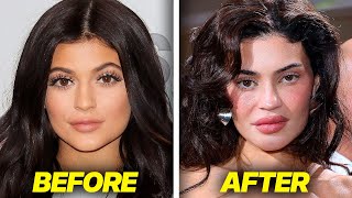People Are WORRIED For Kylie Jenner.. (surgery went too far)