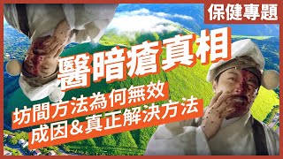 只需兩樣野，就可以快速解決暗瘡！[非廣告]｜為何市面上防痘護膚品無效？｜A酸有效但係……｜｜不是陰謀論｜中文字幕