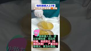 23年的隆胸假体取出后什么样？如需要瞭解更多可以添加V信: jm999778