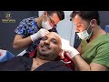 estefuture s patient review from a.s fue hair transplant in turkey