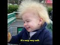 one year old boy has extremely rare ‘uncombable hair syndrome’ l gma