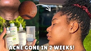 Visibly clearer skin in 2 weeks! Easy 4-step skincare routine ✨