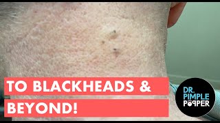 To Blackheads \u0026 Beyond!