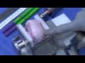 Articular Cartilage Restoration of the Knee: Dr. W. Bugbee