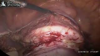 kalawati devi  Laparoscopic Hysterectomy (TLH)