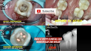 ENDODONTIC \u0026 DIRECT COMPOSITE RESIN FILLING IN MOLAR 2 ADJACENT TO WISDOM TOOTH 🦷 PERAWATAN SARAF ❓