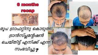 Hair transplantation recap 6 മാസത്തിലേക്ക് ഒരു തിരിഞ്ഞു നോട്ടം  | safvan pullara