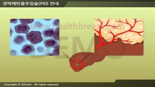 [시연용] c0026abko 축약판 경피에탄올주입술 안내 PEI