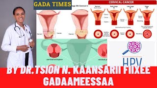 Kaansarii Fiixee Gadaameessaa| cervical cancer| የማጸን ጫፍ ካንሰር|