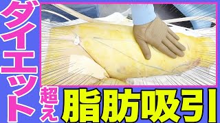 【太もも脂肪吸引】ぽっちゃり体型から劇的に痩せる脂肪吸引！ダイエット/エステ/筋トレ/で痩せない方への裏技！