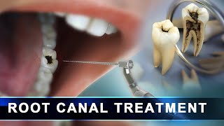 Root Canal Treatment step by step |  Curveia Dental Animation in 3D - Endodontic