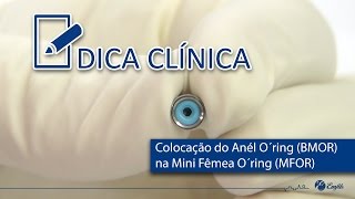 Colocação do Anel O´ring na Mini Fêmea do Pilar de Retenção Emfils