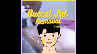 Shens Clinic | Buccal Fat Removal (Cheek Fat Reduction)