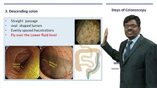 colonoscopy, step by step 🚶♀️. Basics and summary