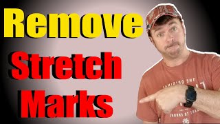 ERASE THOSE STRETCH MARKS FOR GOOD | CHRIS GIBSON