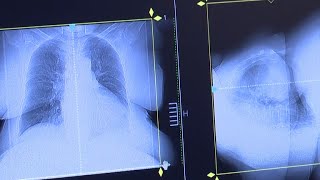 New concerns about lung cancer risk in young women